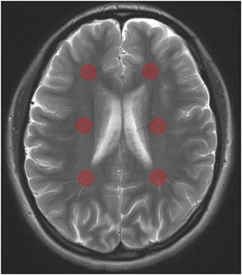 Amide Proton Transfer Weighted Imaging Shows Differences in Multiple Sclerosis Lesions and White Matter Hyperintensities of Presumed Vascular Origin